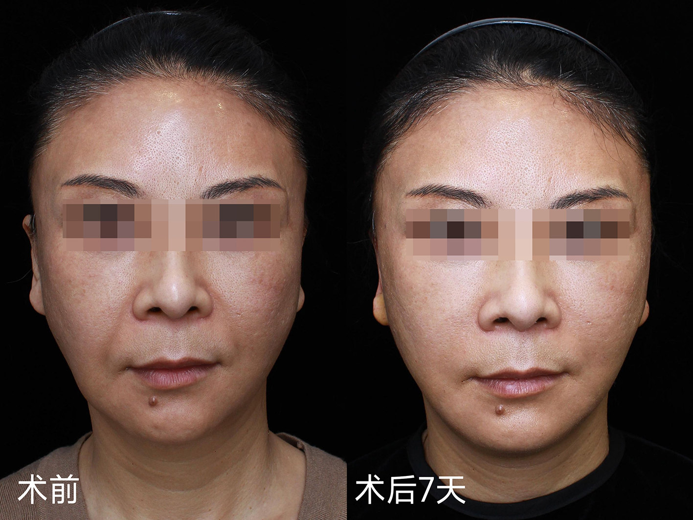 不用填充也能改善法令纹？真人案例现身说法