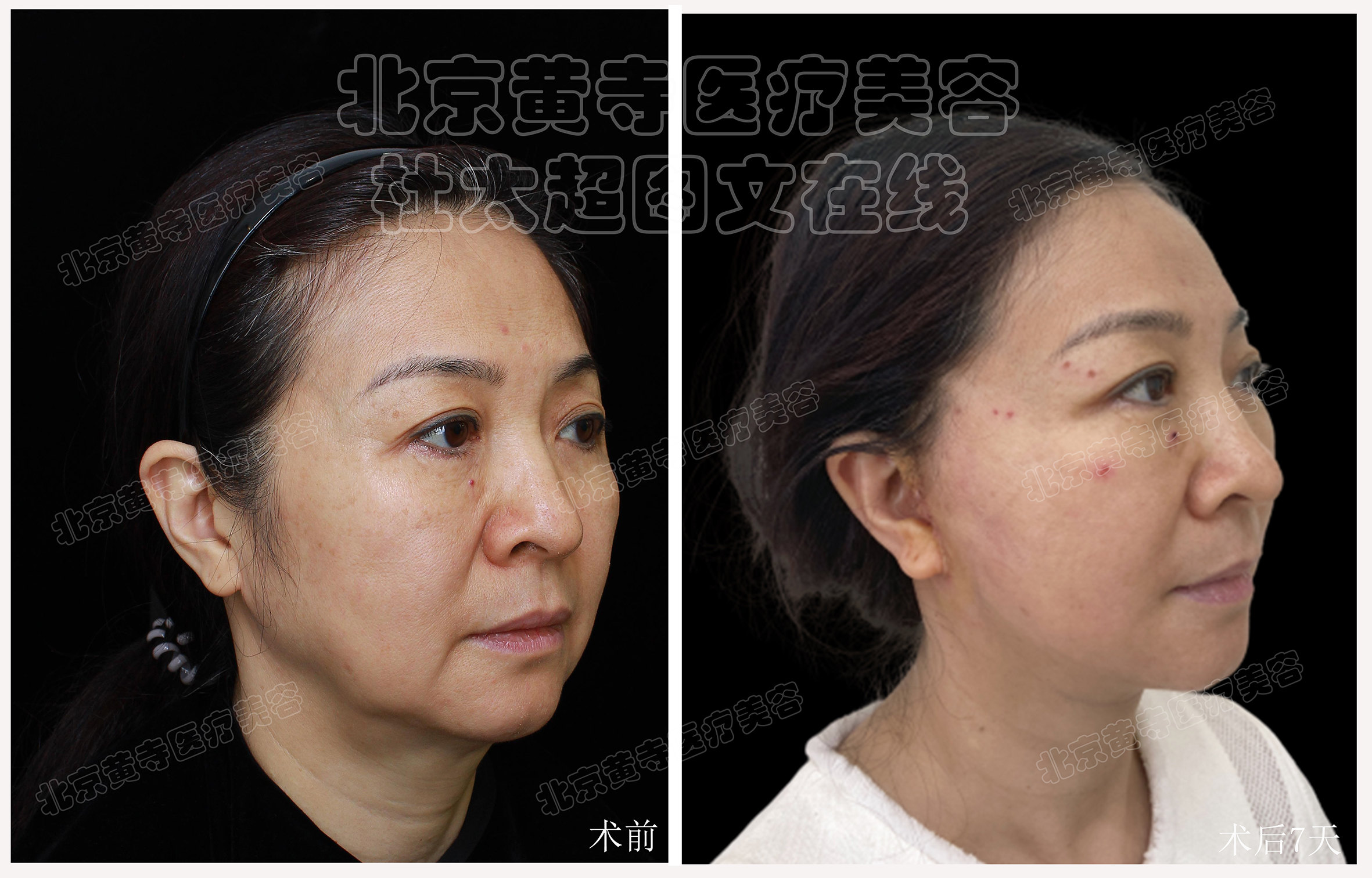 拉皮面部提升术后随访7天