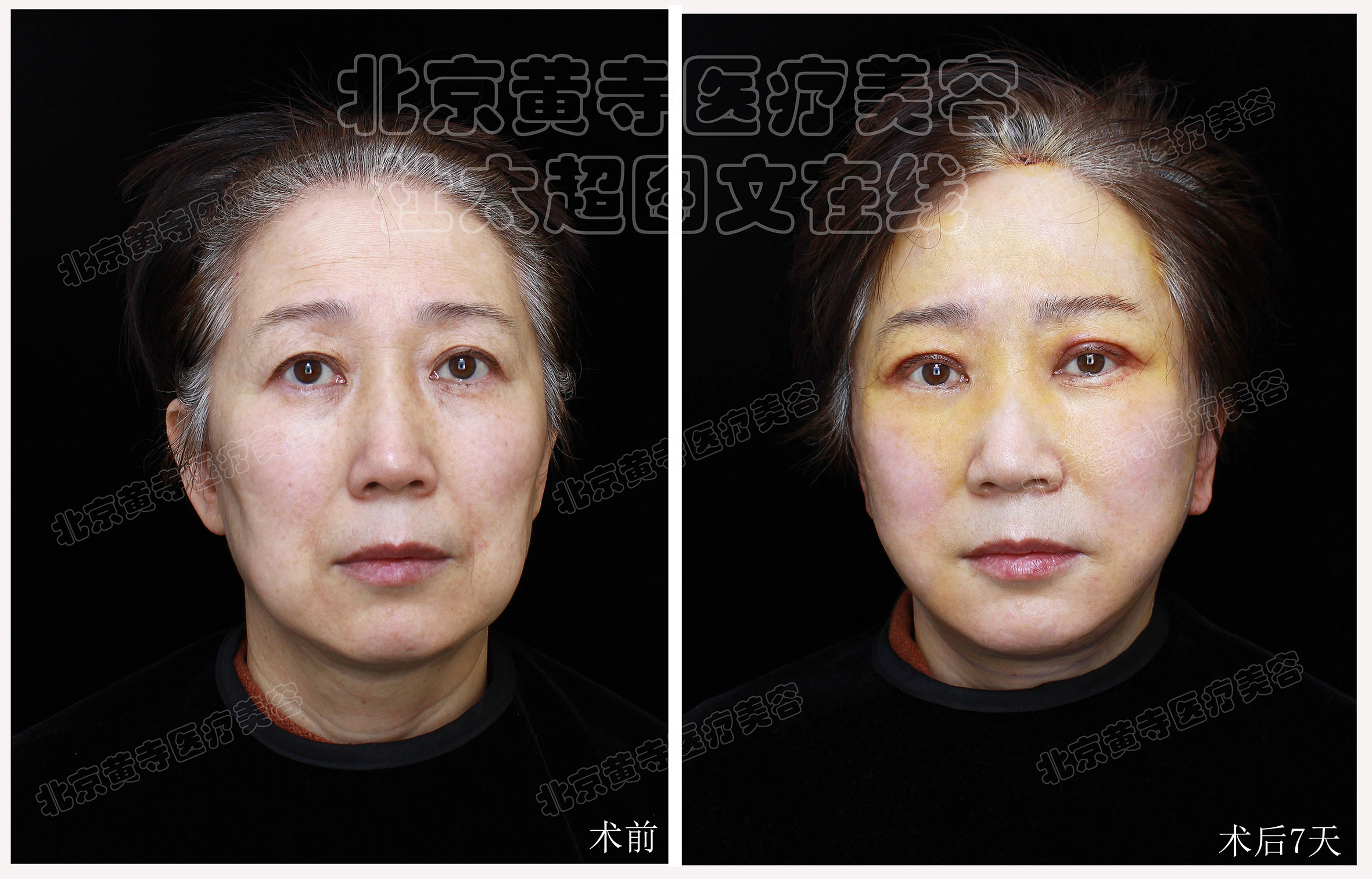 拉皮面部提升术后7天