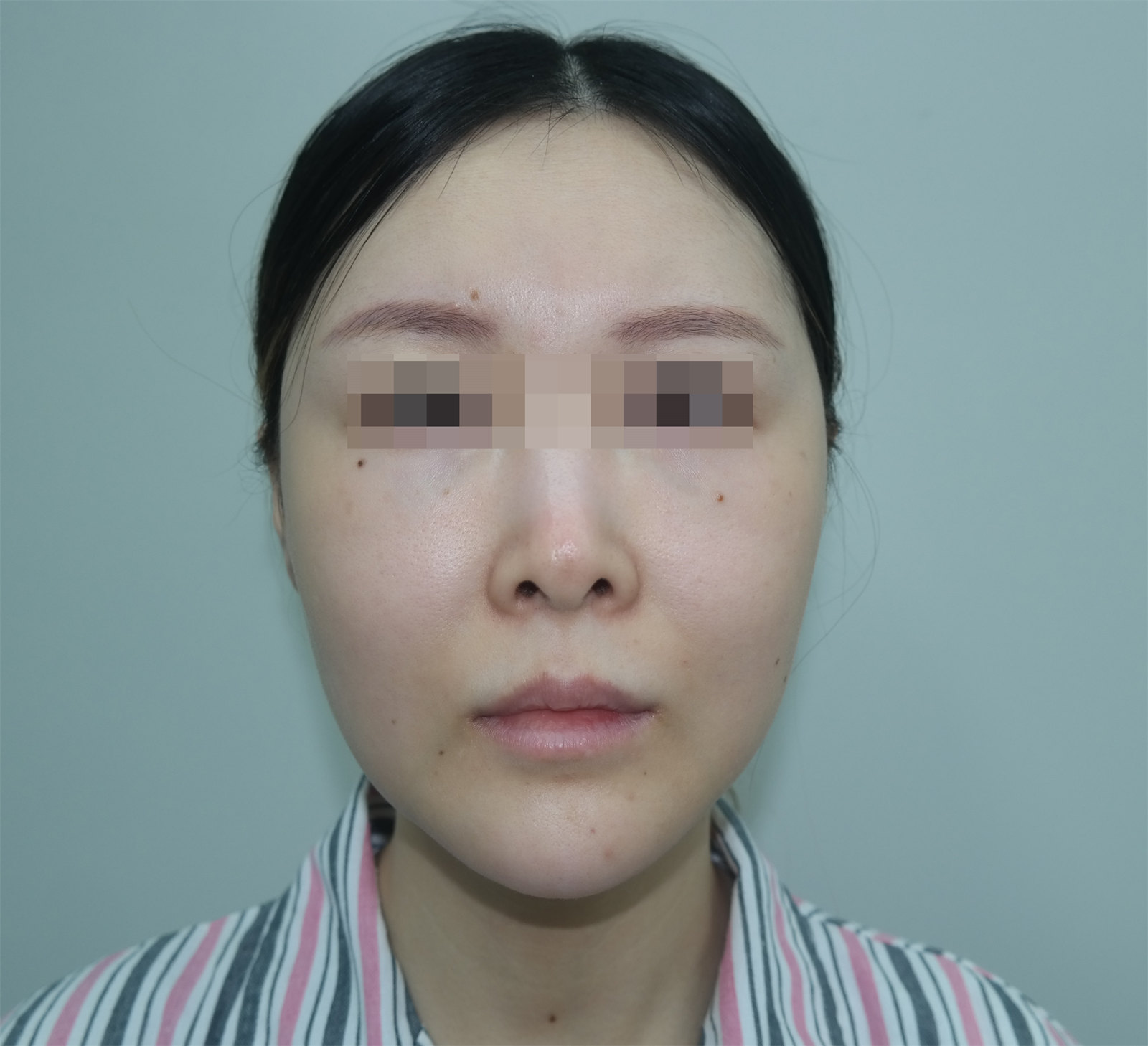 36岁女士拉皮全程记录,术后7天减龄、少女感十足! 36岁女士拉皮全程记录,术后7天减龄、少女感十足!