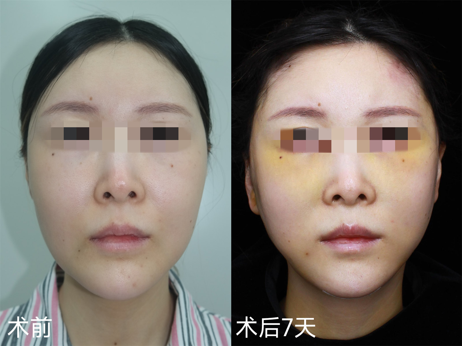 36岁女士拉皮全程记录,术后7天减龄、少女感十足! 36岁女士拉皮全程记录,术后7天减龄、少女感十足!