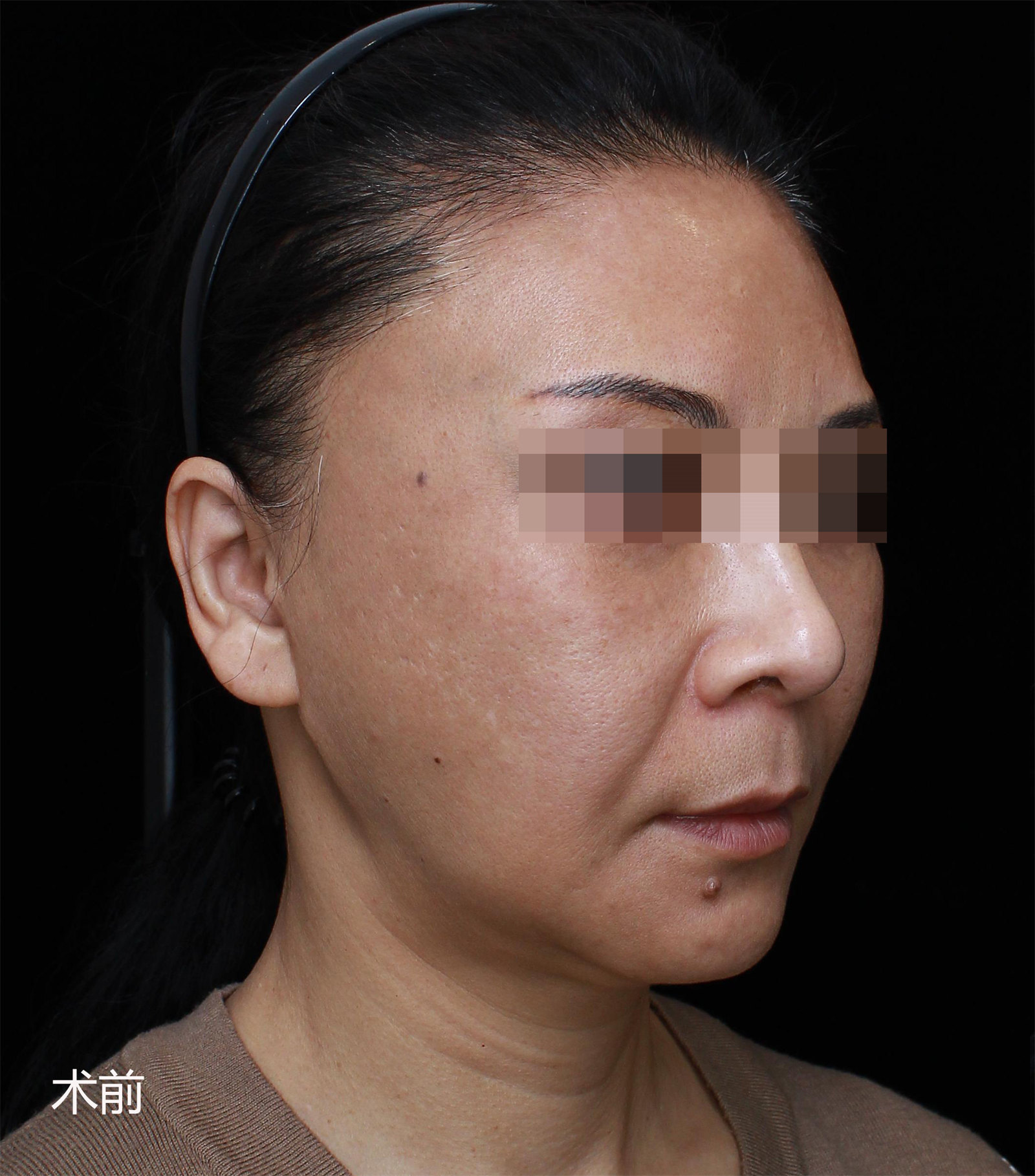 53岁做第二次拉皮手术，效果终于让我满意了！悟出真相