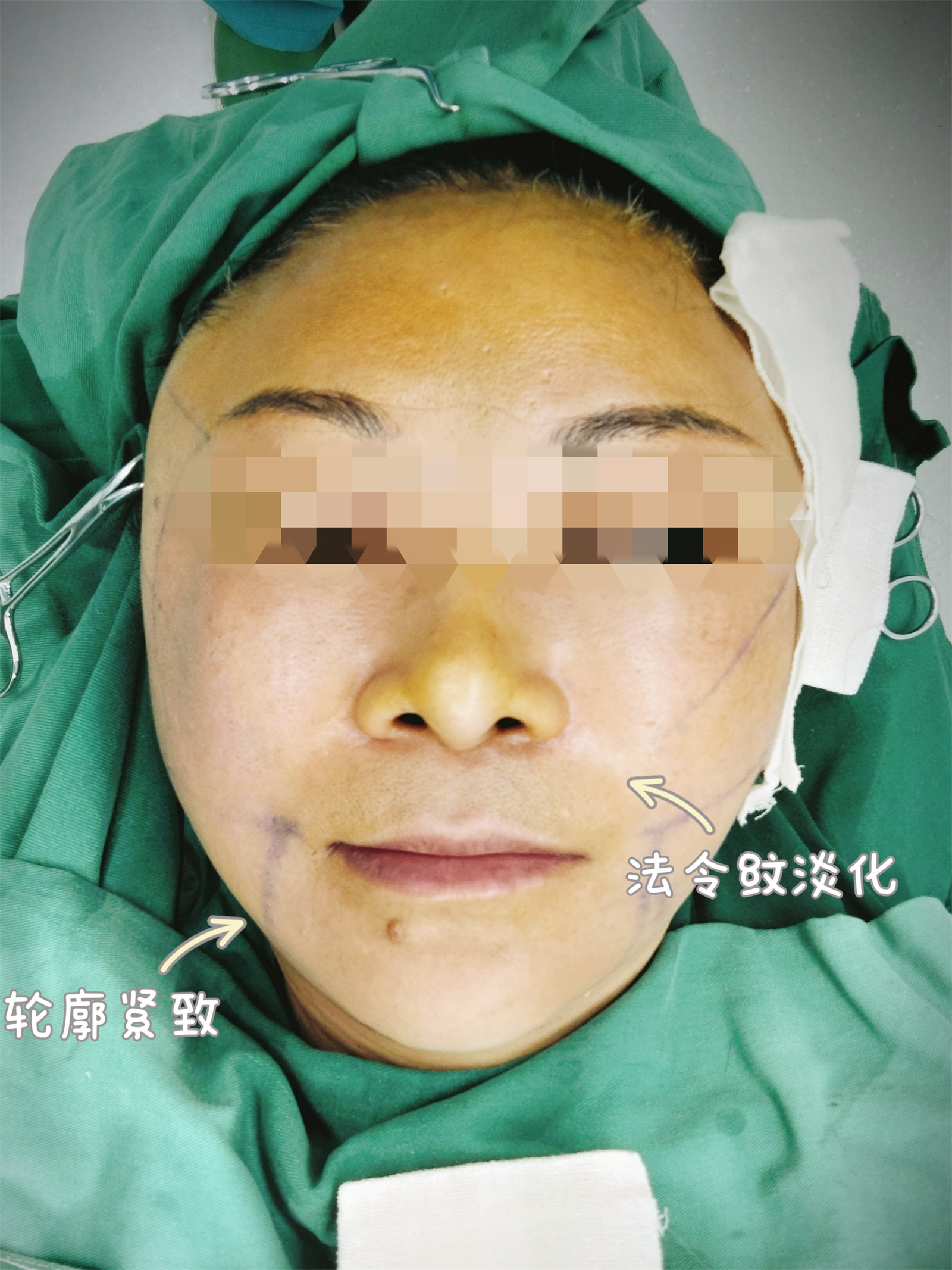 53岁做第二次拉皮手术，效果终于让我满意了！悟出真相