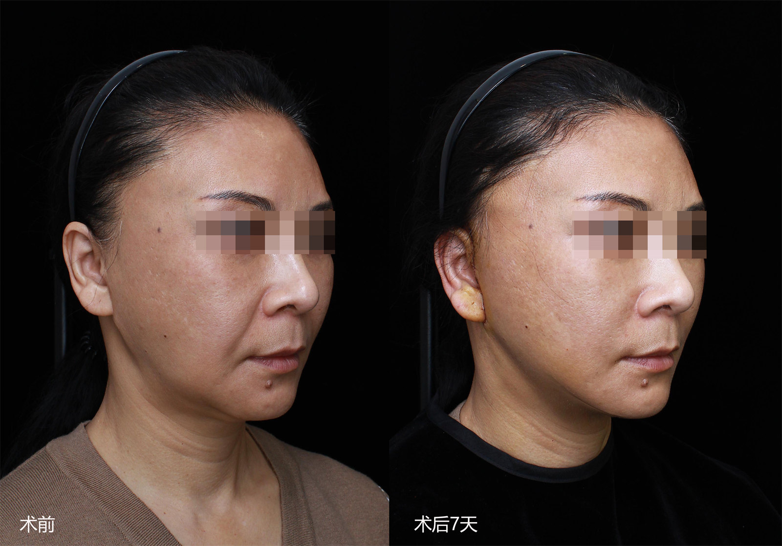 53岁做第二次拉皮手术，效果终于让我满意了！悟出真相