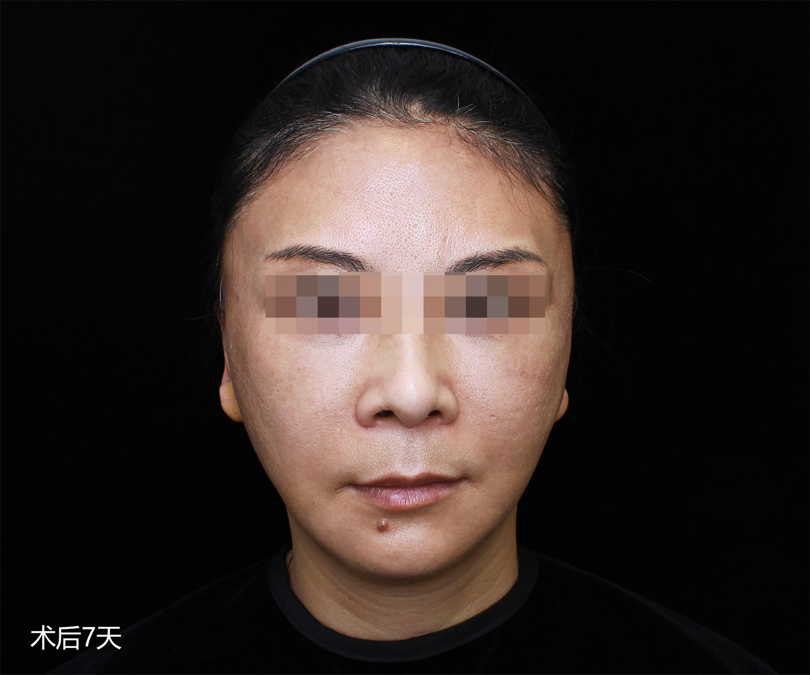 53岁做第二次拉皮手术，效果终于让我满意了！悟出真相