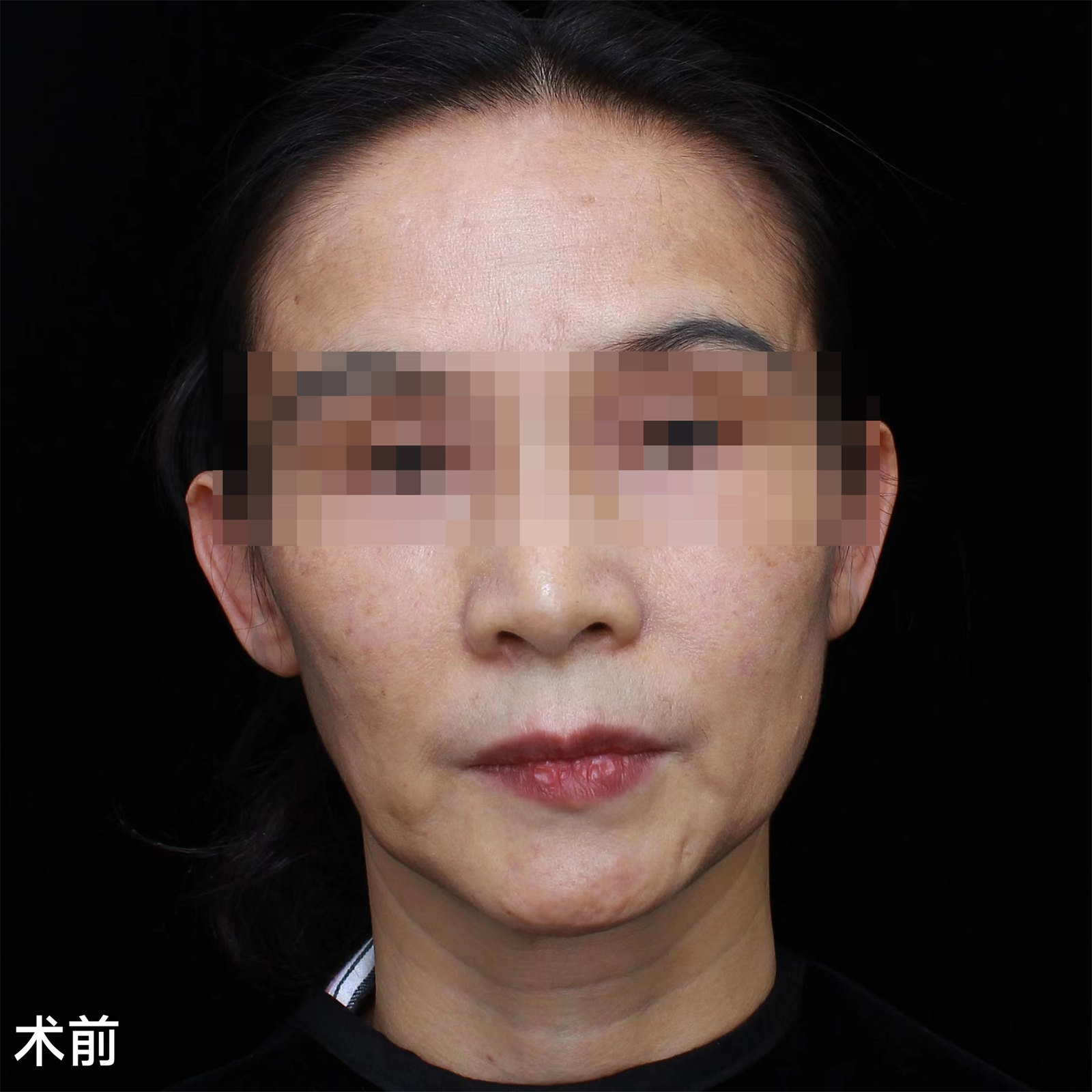 45岁比同龄人显老,不甘心向岁月妥协,做了拉皮手术! 45岁比同龄人显老,不甘心向岁月妥协,做了拉皮手术!