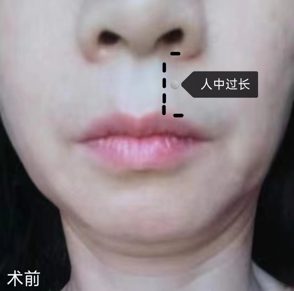 45岁比同龄人显老,不甘心向岁月妥协,做了拉皮手术! 45岁比同龄人显老,不甘心向岁月妥协,做了拉皮手术!