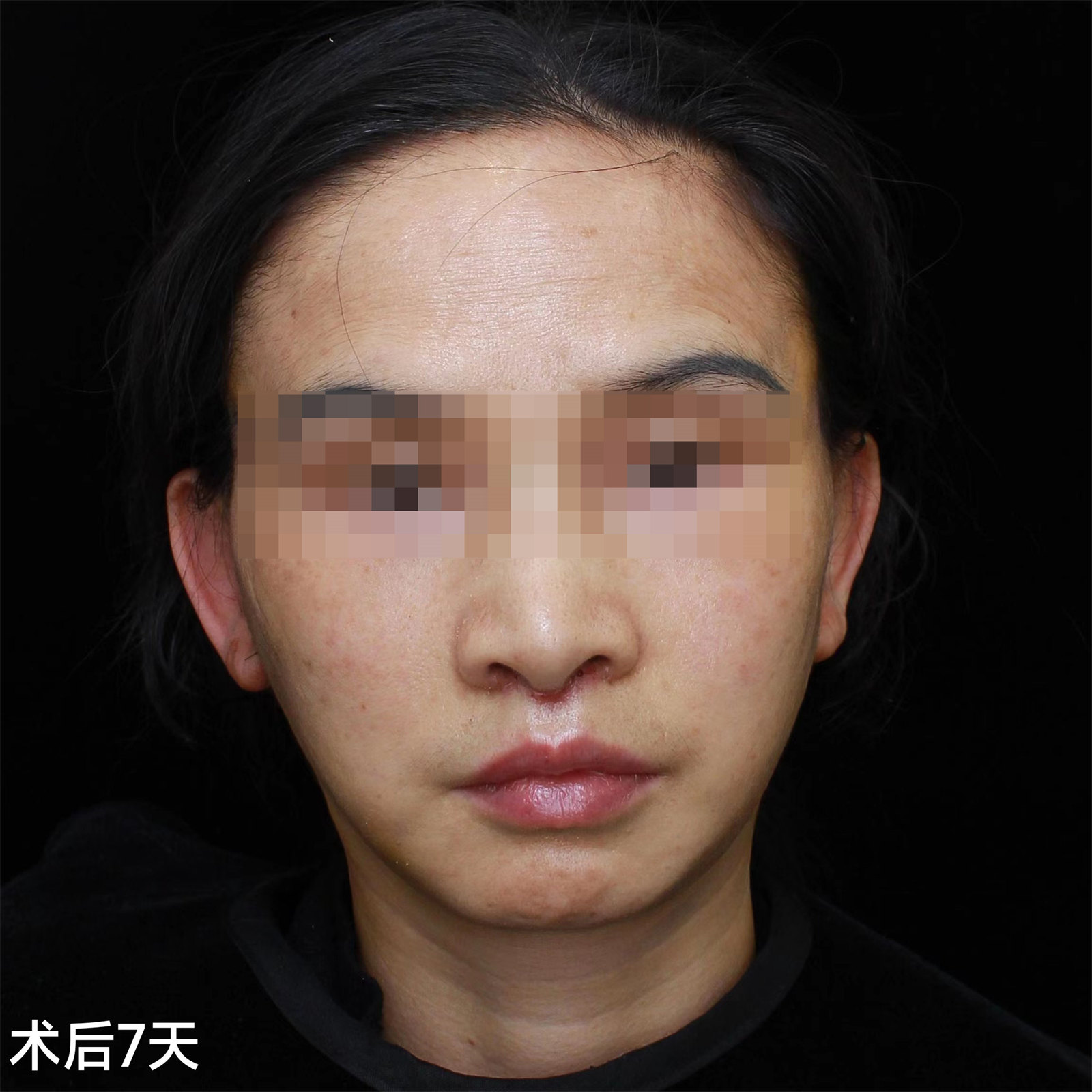 45岁比同龄人显老,不甘心向岁月妥协,做了拉皮手术! 45岁比同龄人显老,不甘心向岁月妥协,做了拉皮手术!