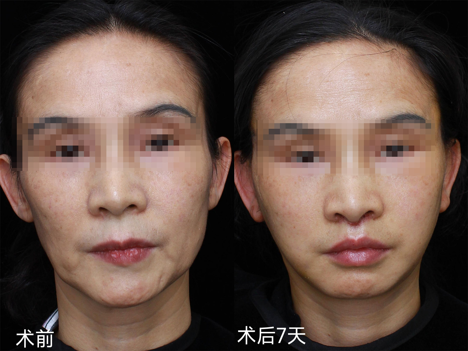 45岁比同龄人显老,不甘心向岁月妥协,做了拉皮手术! 45岁比同龄人显老,不甘心向岁月妥协,做了拉皮手术!