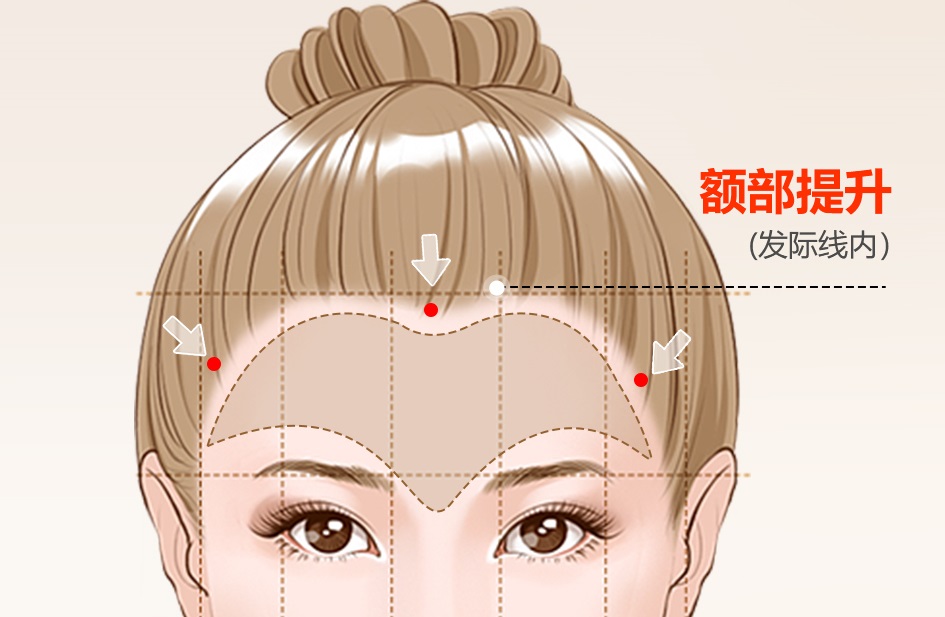 50+做完上面部除皱,术后2个月川字纹、额纹都不见了 50+做完上面部除皱,术后2个月川字纹、额纹都不见了