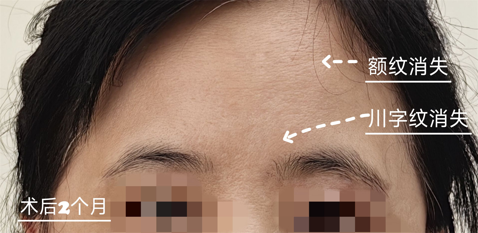 50+做完上面部除皱,术后2个月川字纹、额纹都不见了 50+做完上面部除皱,术后2个月川字纹、额纹都不见了
