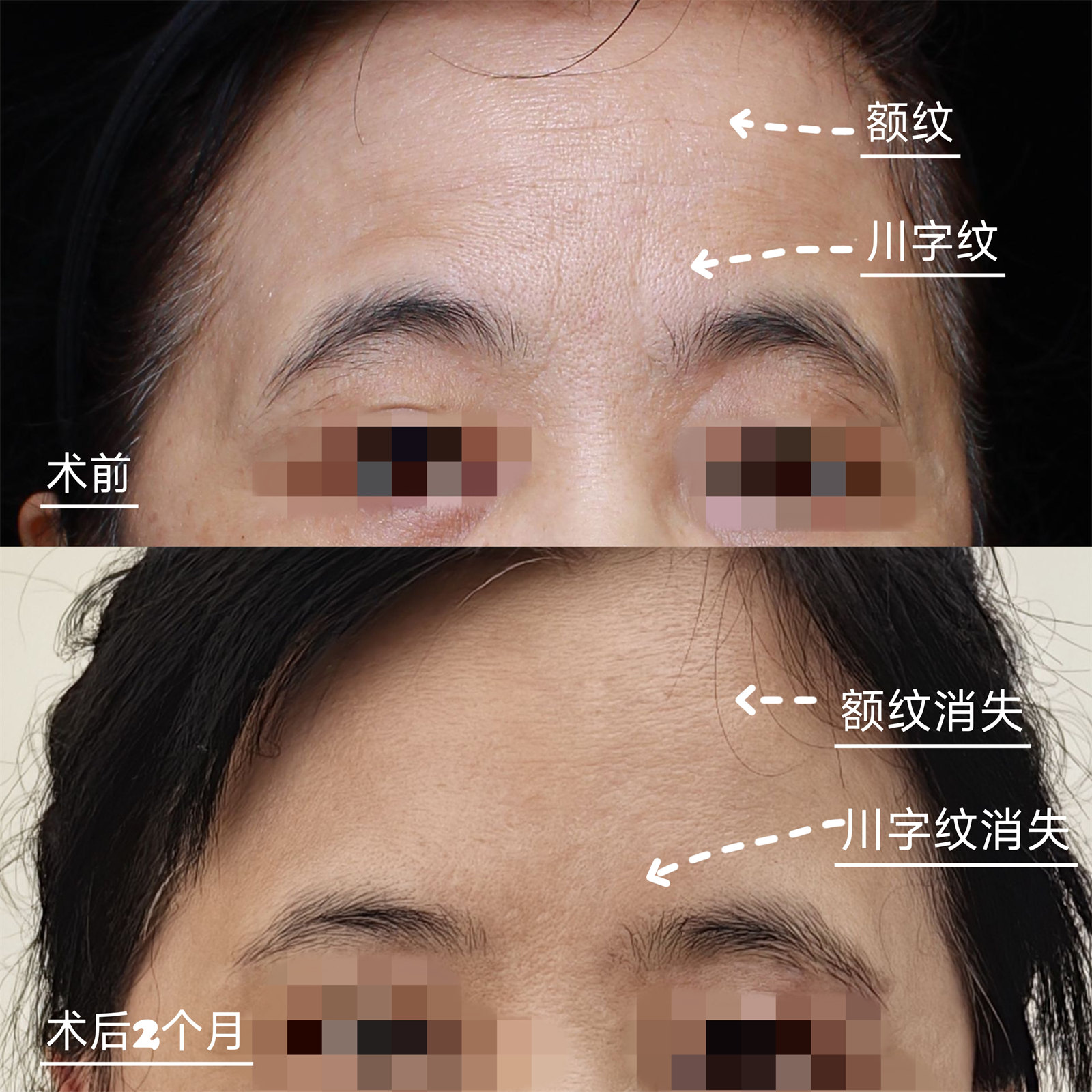 50+做完上面部除皱,术后2个月川字纹、额纹都不见了 50+做完上面部除皱,术后2个月川字纹、额纹都不见了