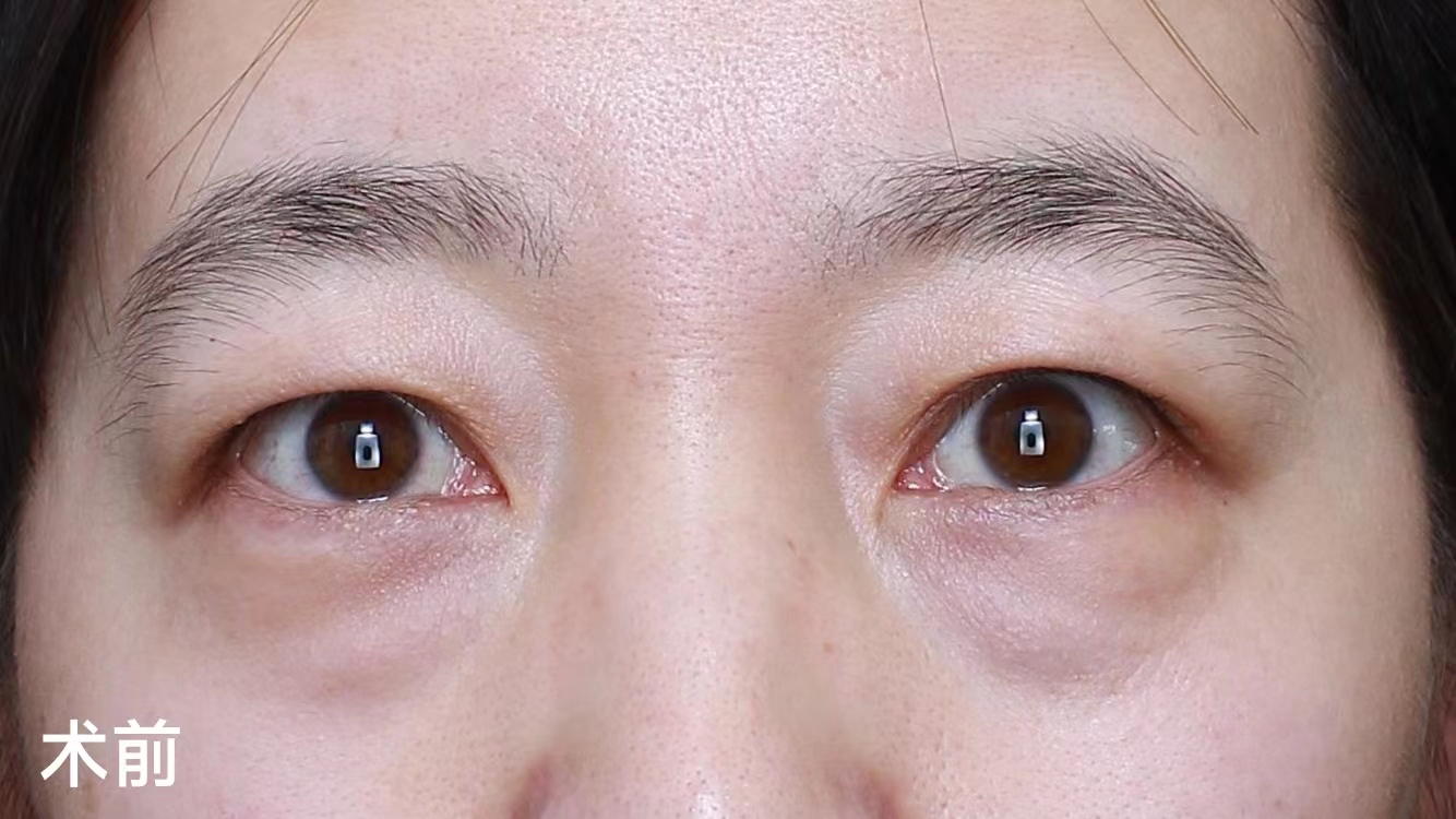 年轻人眼周衰老,对症下药这样做! 年轻人眼周衰老,对症下药这样做!