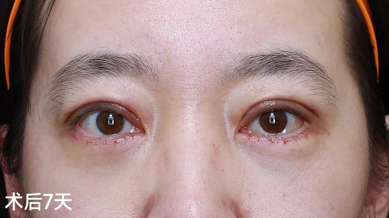 年轻人眼周衰老,对症下药这样做! 年轻人眼周衰老,对症下药这样做!