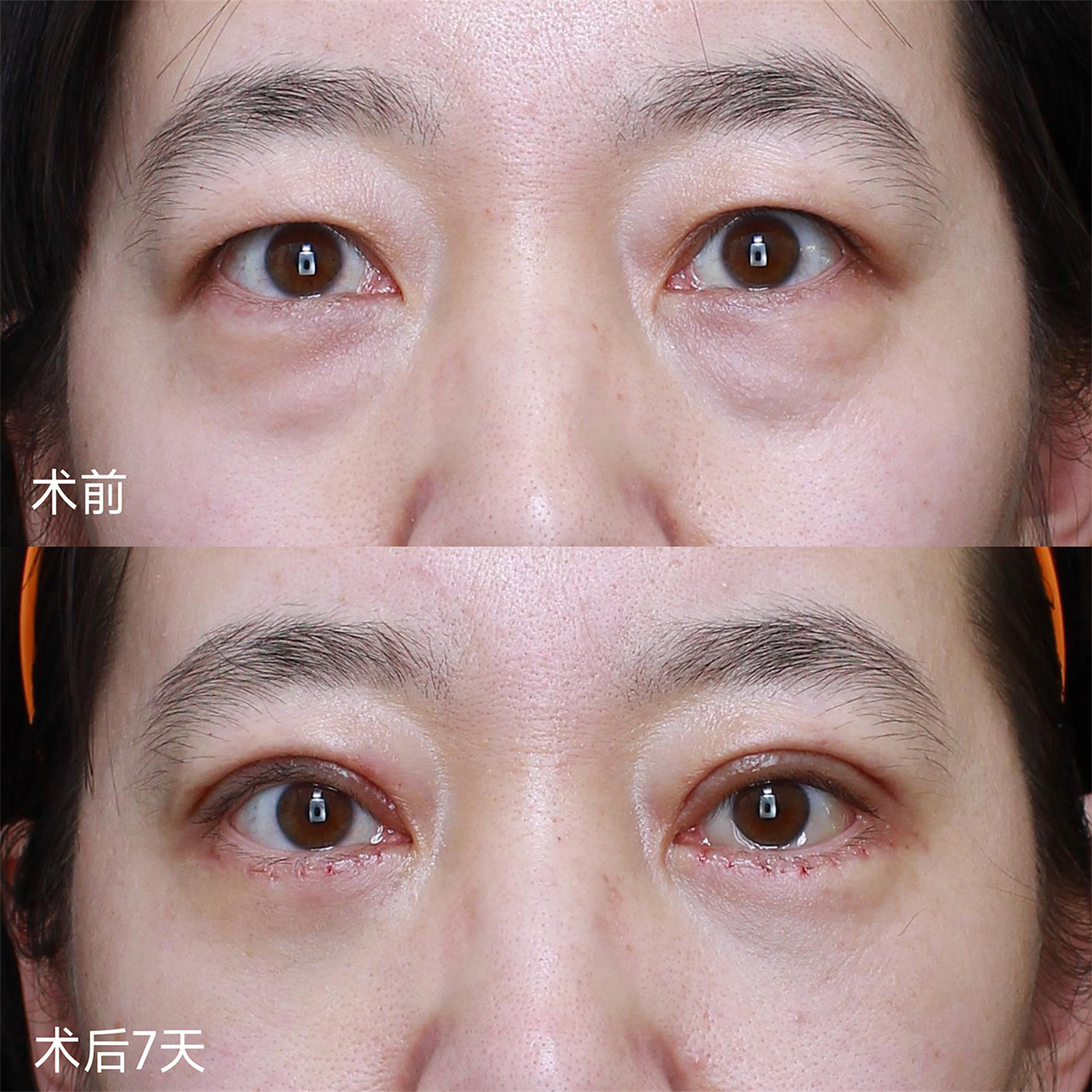 年轻人眼周衰老,对症下药这样做! 年轻人眼周衰老,对症下药这样做!