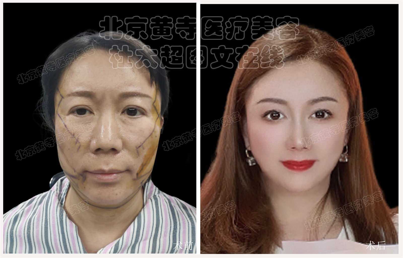 拉皮面部提升术后随访