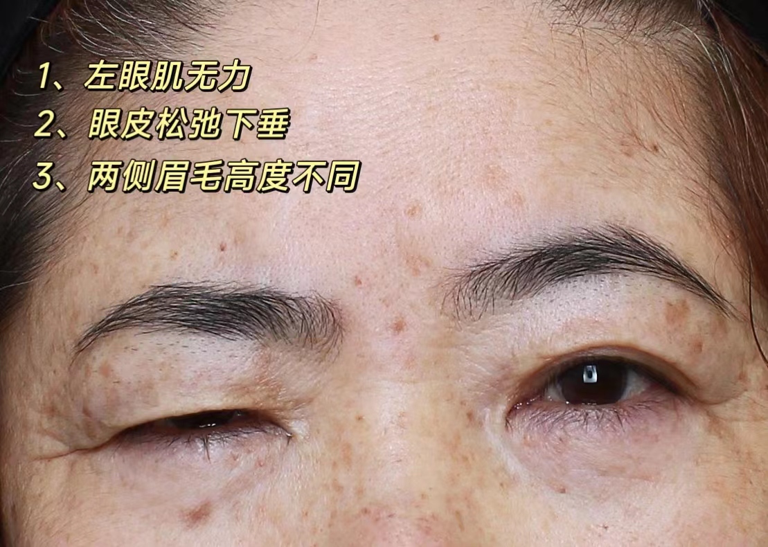 病理性眼部肌无力,这样做,可实现自主抬起上眼睑! 病理性眼部肌无力,这样做,可实现自主抬起上眼睑!