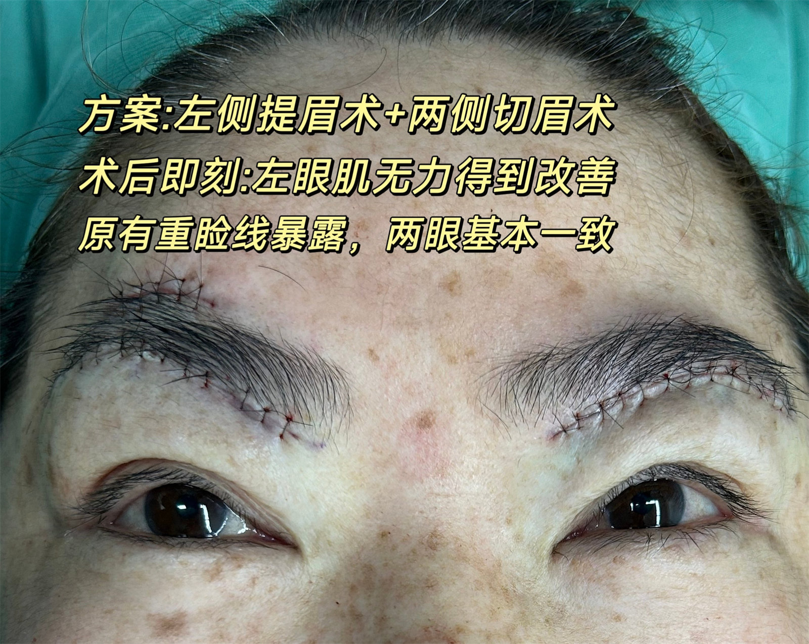 病理性眼部肌无力,这样做,可实现自主抬起上眼睑! 病理性眼部肌无力,这样做,可实现自主抬起上眼睑!