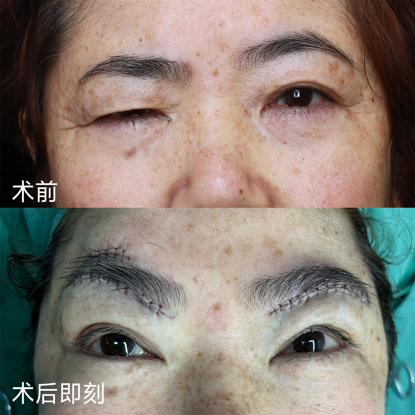 病理性眼部肌无力,这样做,可实现自主抬起上眼睑! 病理性眼部肌无力,这样做,可实现自主抬起上眼睑!