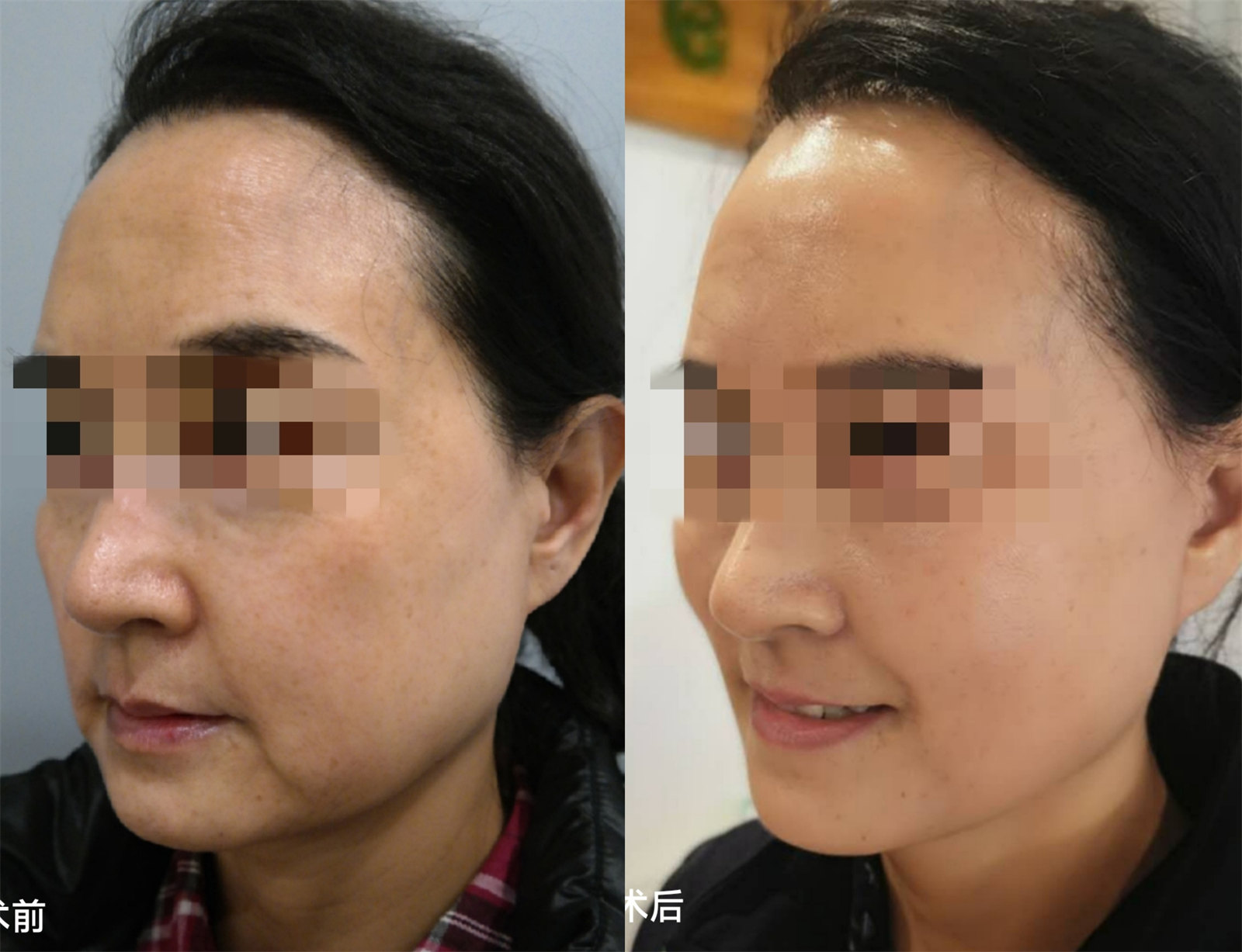 医美小白做拉皮手术前,应如何正确避坑? 医美小白做拉皮手术前,应如何正确避坑?