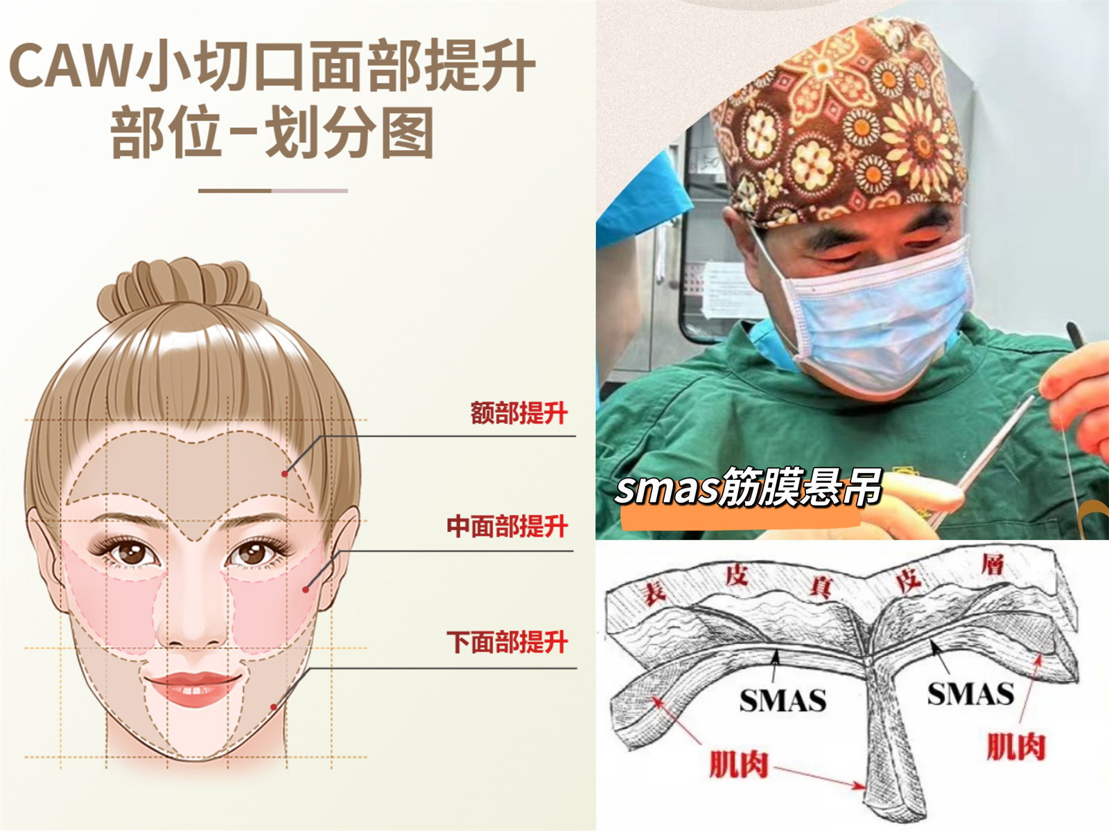 50岁+想做拉皮手术,要做好这3点心理准备! 50岁+想做拉皮手术,要做好这3点心理准备!