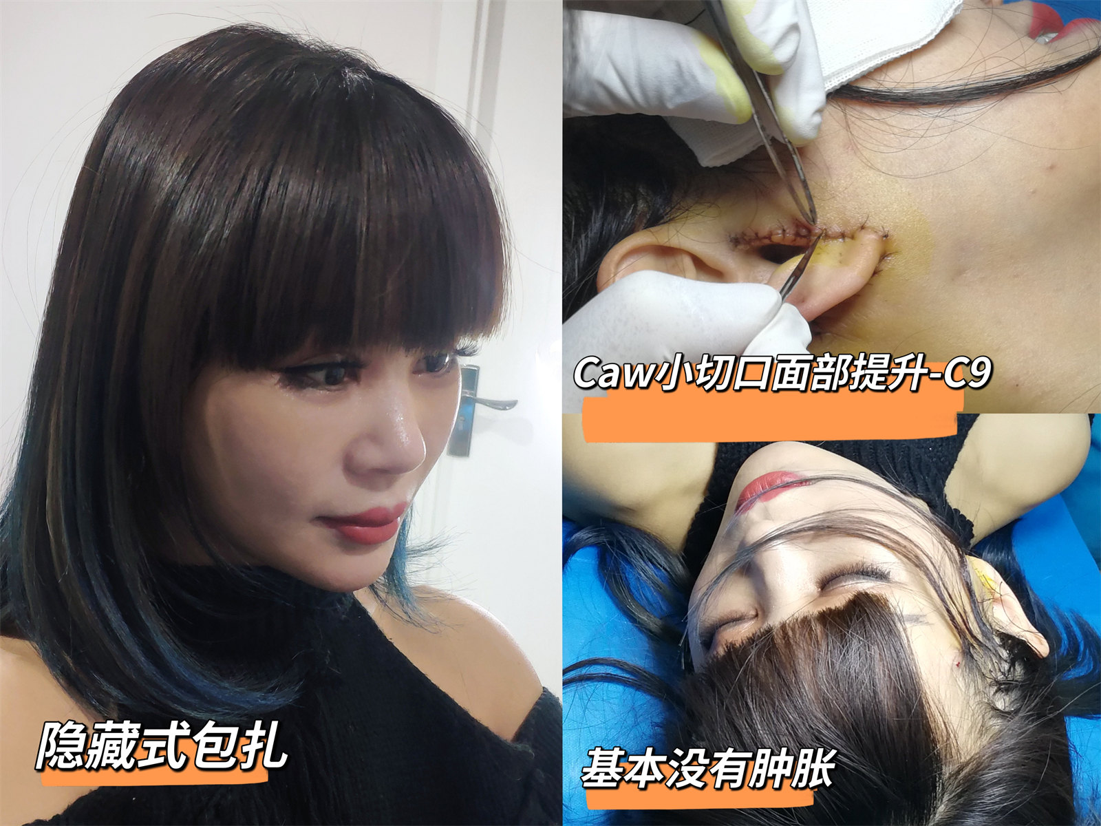 50岁+想做拉皮手术,要做好这3点心理准备! 50岁+想做拉皮手术,要做好这3点心理准备!