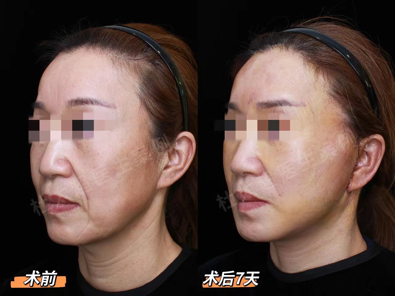 50岁+想做拉皮手术,要做好这3点心理准备! 50岁+想做拉皮手术,要做好这3点心理准备!