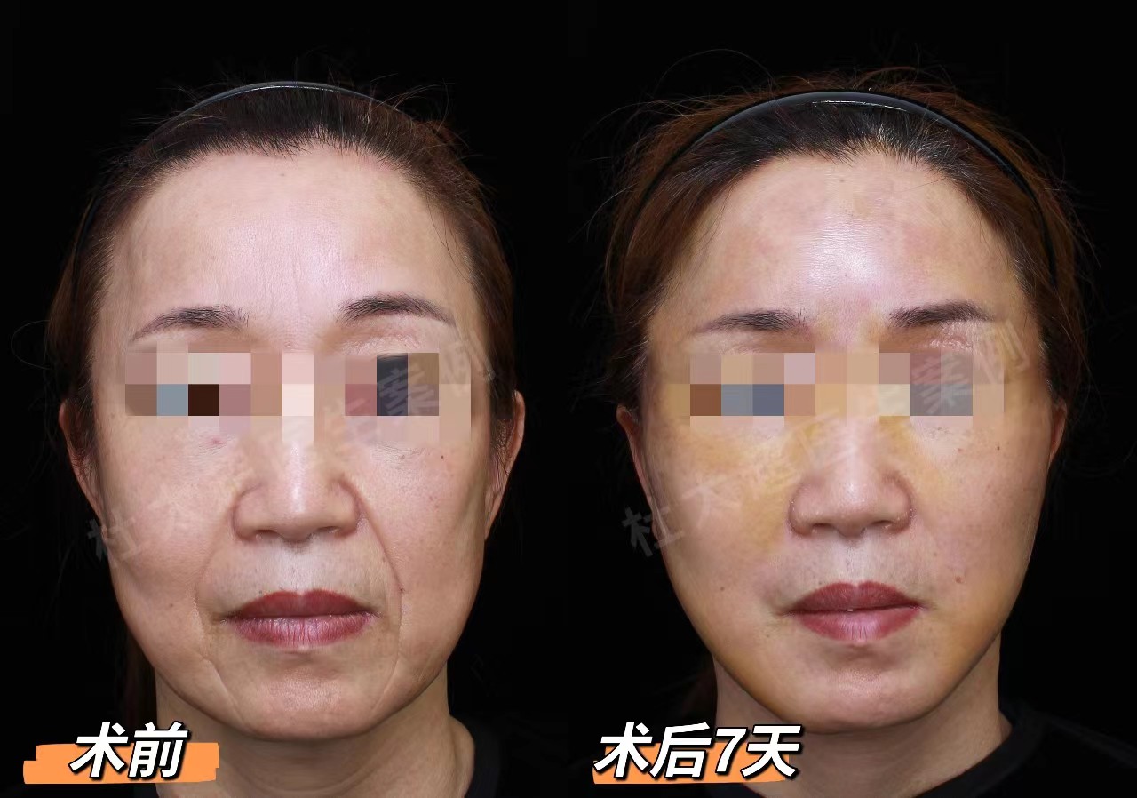 50岁+想做拉皮手术,要做好这3点心理准备! 50岁+想做拉皮手术,要做好这3点心理准备!