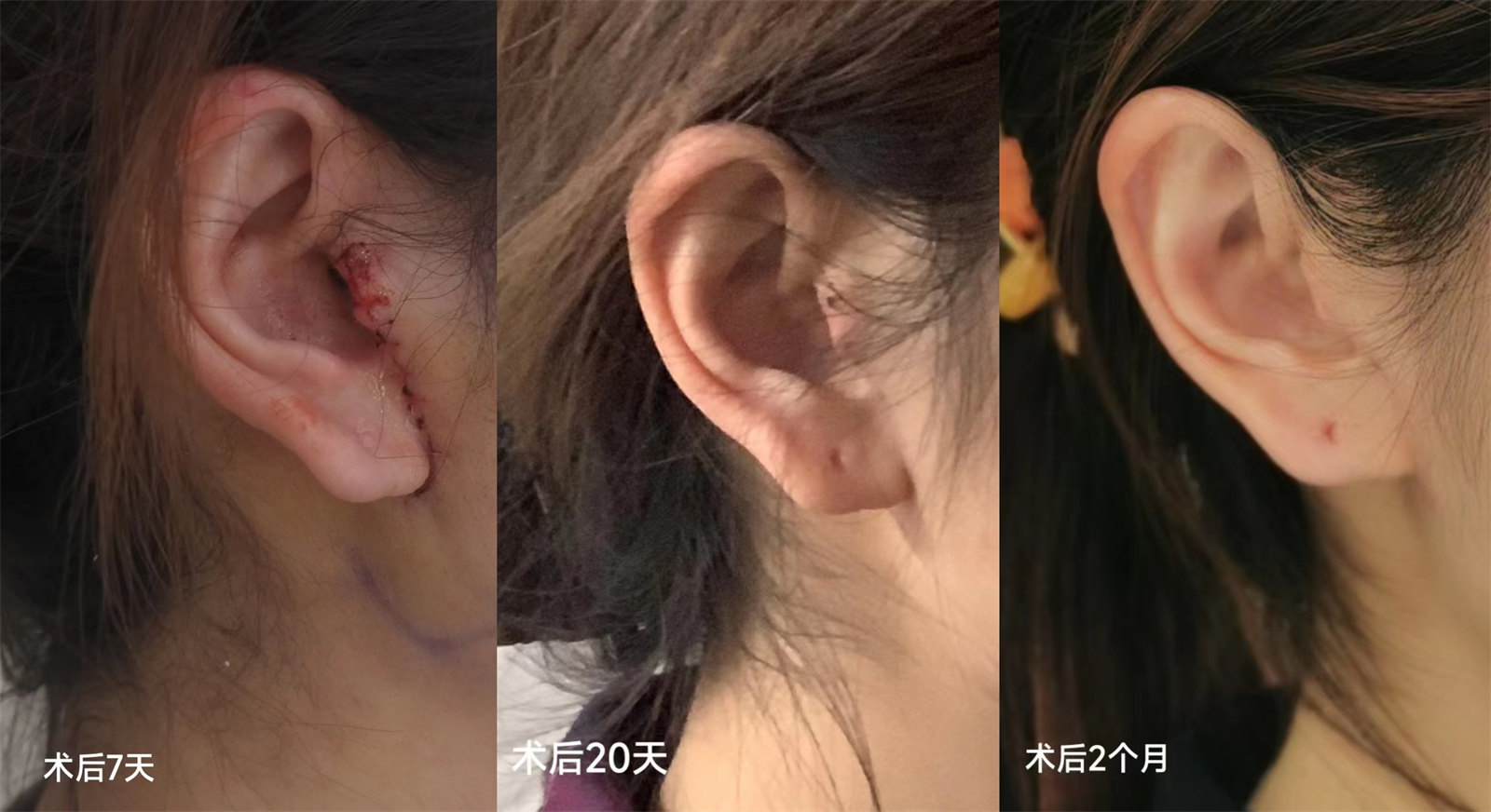 关于拉皮手术,你最关心的三件事,答案全在这里! 关于拉皮手术,你最关心的三件事,答案全在这里!