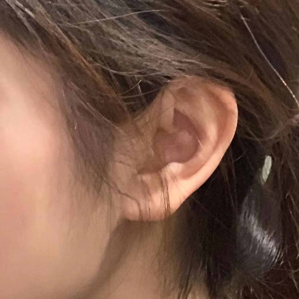 关于拉皮手术,你最关心的三件事,答案全在这里! 关于拉皮手术,你最关心的三件事,答案全在这里!