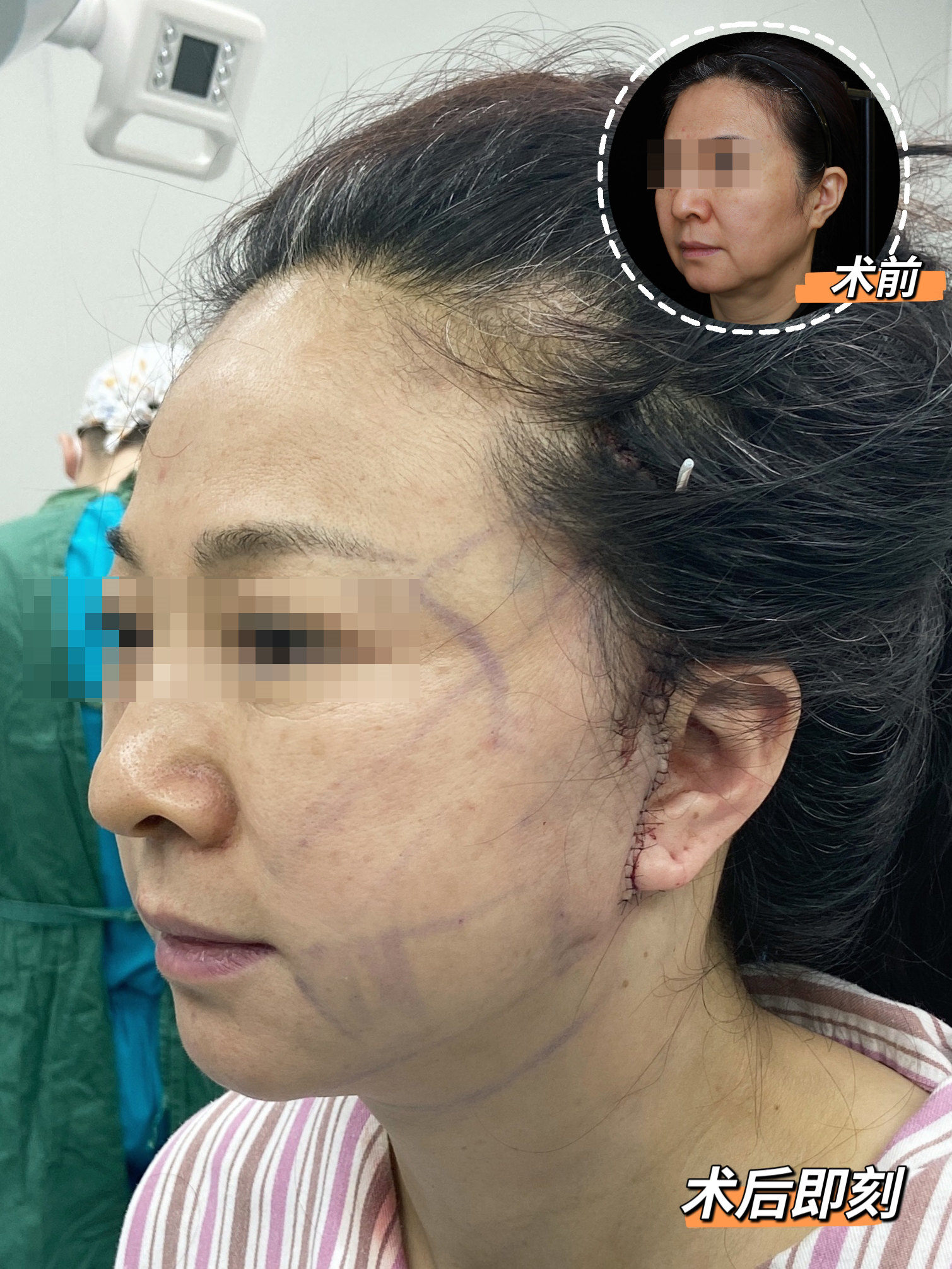 关于拉皮手术,你最关心的三件事,答案全在这里! 关于拉皮手术,你最关心的三件事,答案全在这里!