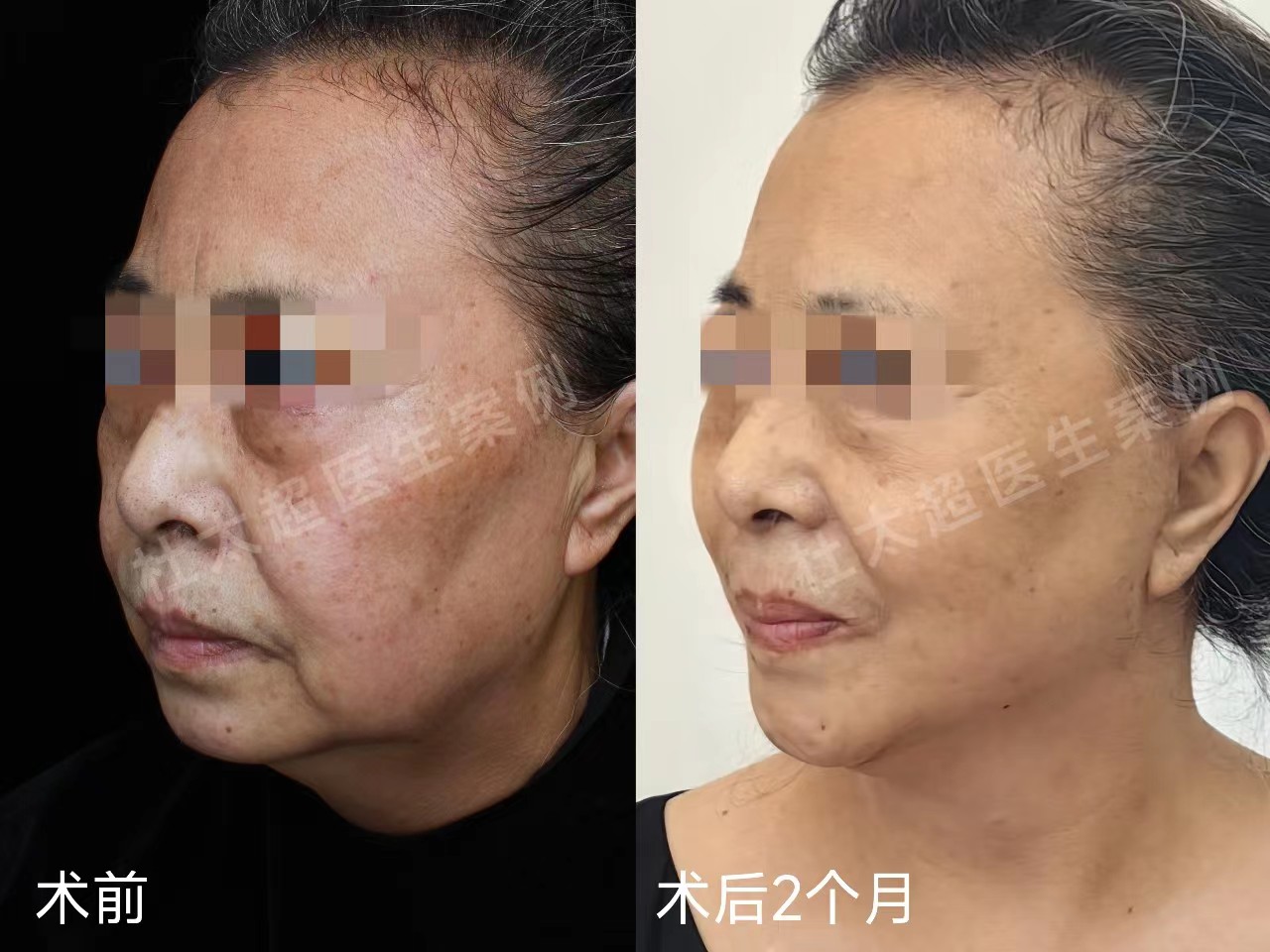 60岁求美者拉皮手术2个月,真实经验分享 60岁求美者拉皮手术2个月,真实经验分享