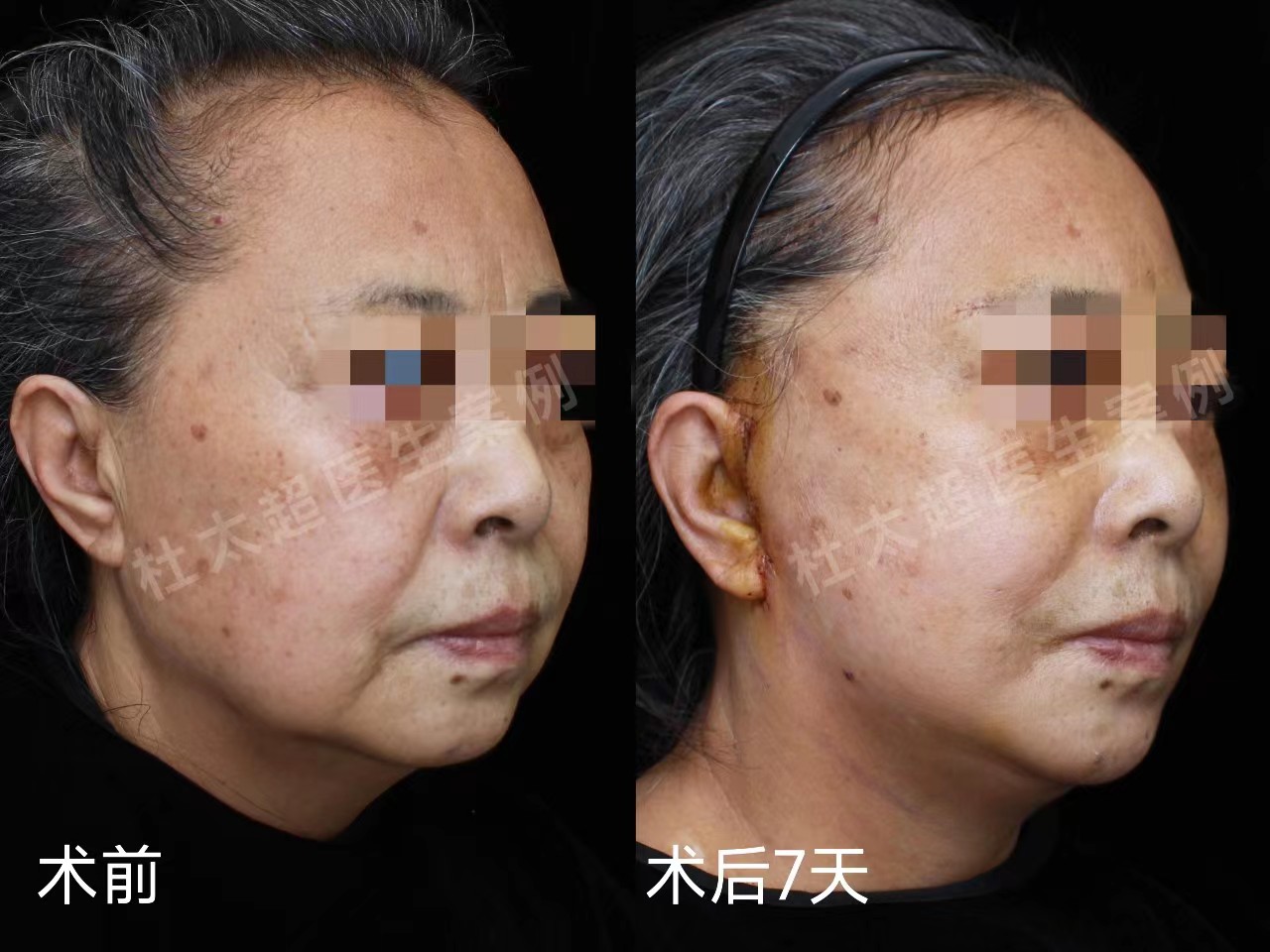 60岁求美者拉皮手术2个月,真实经验分享 60岁求美者拉皮手术2个月,真实经验分享