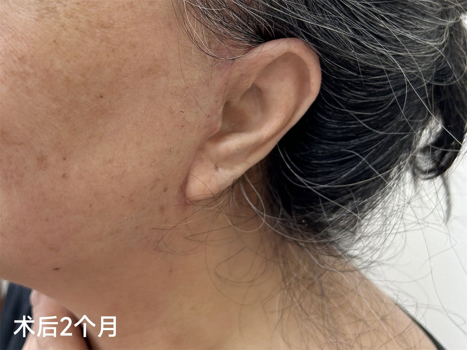 60岁求美者拉皮手术2个月,真实经验分享 60岁求美者拉皮手术2个月,真实经验分享