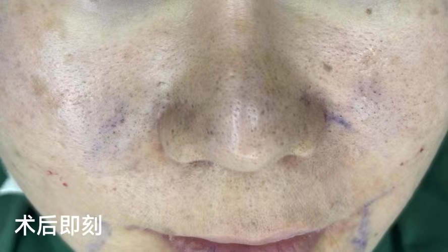 奔着淡化法令纹做了拉皮手术,结果法令纹消失了,太惊喜! 奔着淡化法令纹做了拉皮手术,结果法令纹消失了,太惊喜!