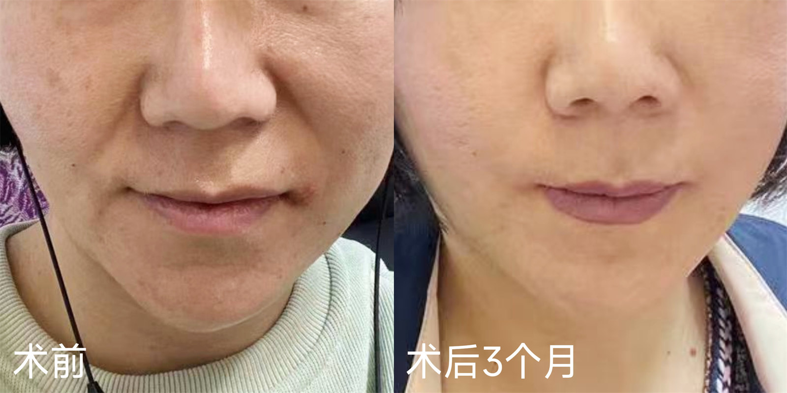 奔着淡化法令纹做了拉皮手术,结果法令纹消失了,太惊喜! 奔着淡化法令纹做了拉皮手术,结果法令纹消失了,太惊喜!