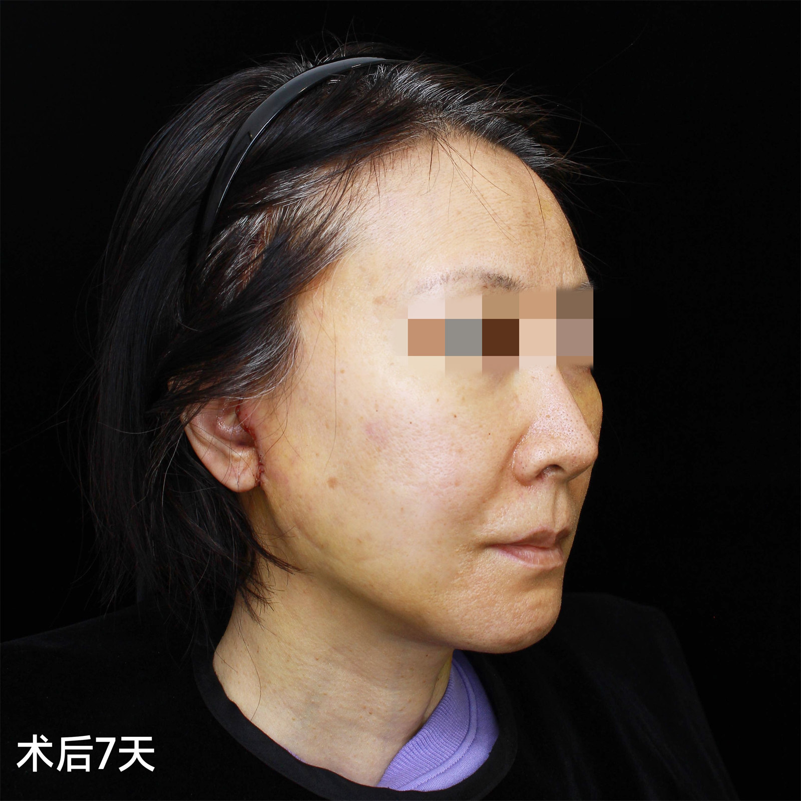 53岁选择做了拉皮手术，迎来了迟到10年的逆龄之旅