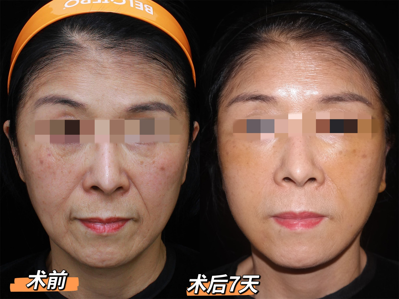 60岁做了拉皮手术,术后7天“大变样”! 60岁做了拉皮手术,术后7天“大变样”!