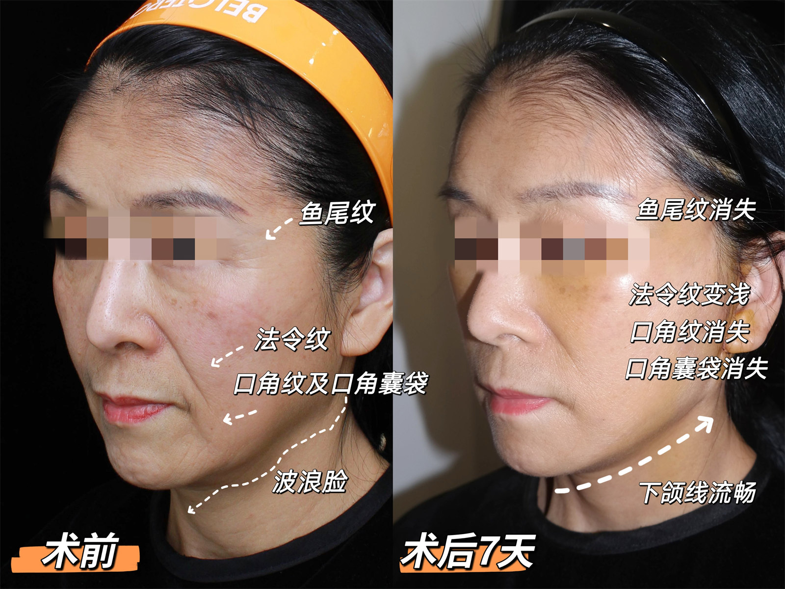 60岁做了拉皮手术,术后7天“大变样”! 60岁做了拉皮手术,术后7天“大变样”!