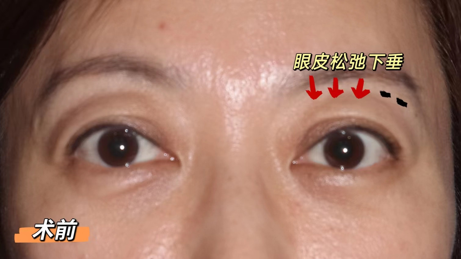 做完切眉术后10天，分享真实术后恢复过程