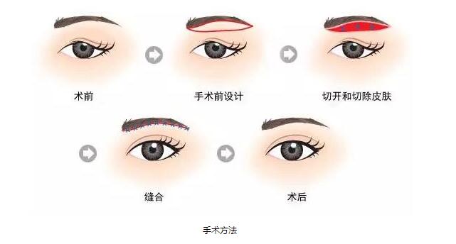 做完切眉术后10天，分享真实术后恢复过程