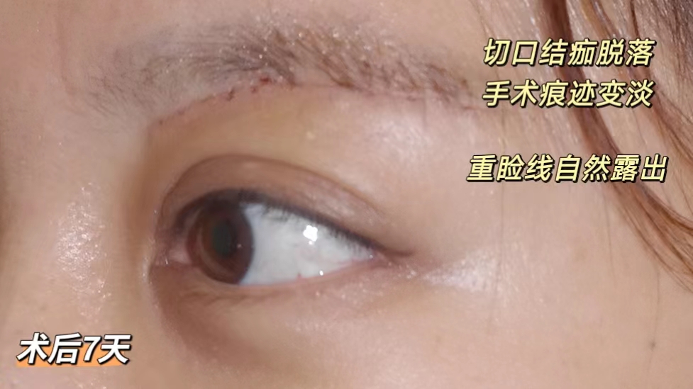 做完切眉术后10天，分享真实术后恢复过程