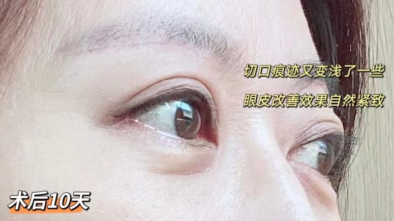 做完切眉术后10天，分享真实术后恢复过程
