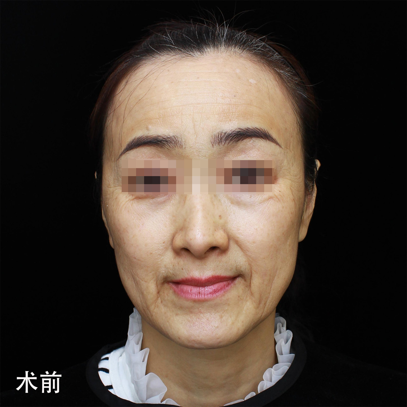 拉皮手术成功后的第7天，赢麻了！