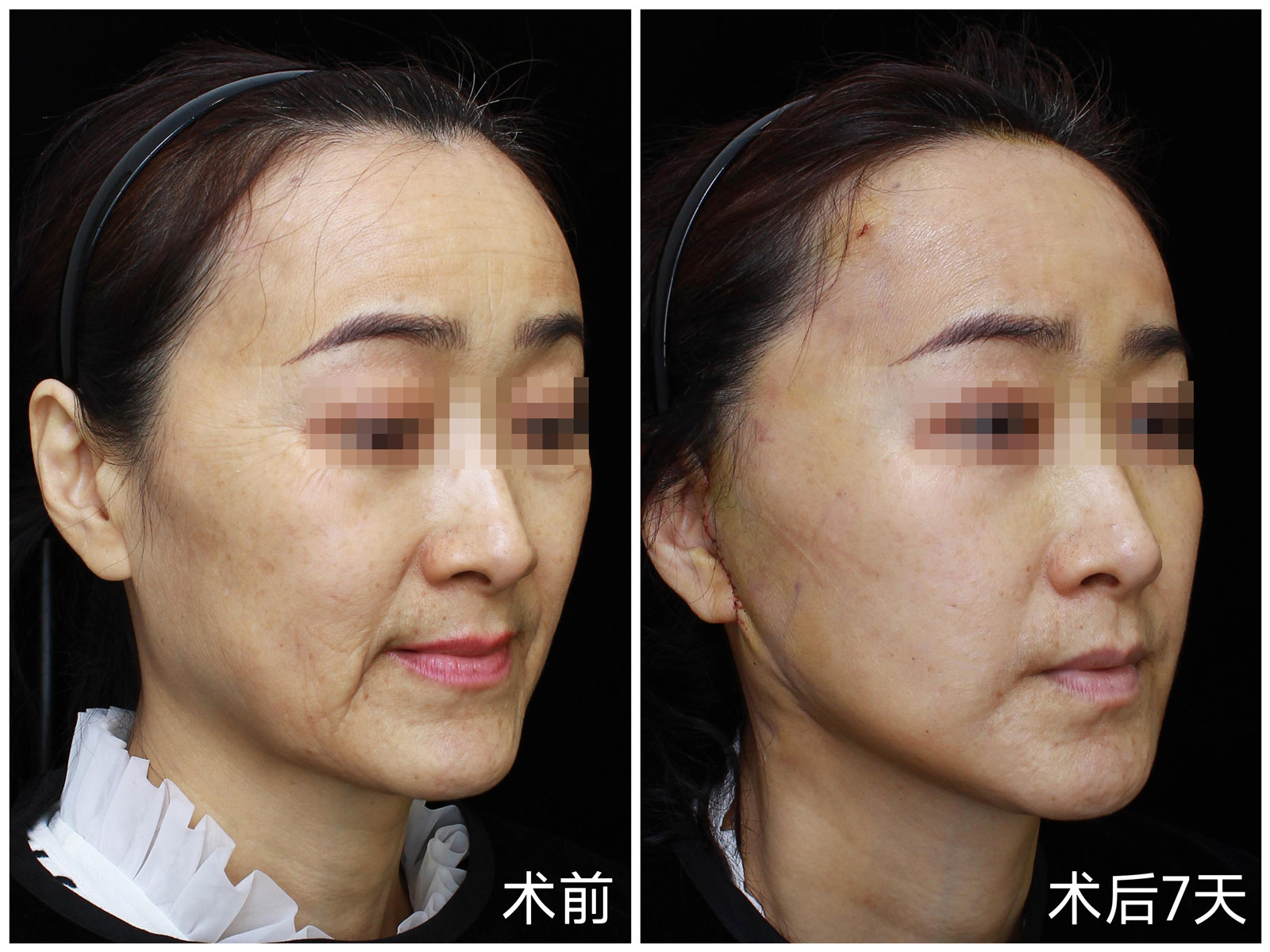 拉皮手术成功后的第7天，赢麻了！