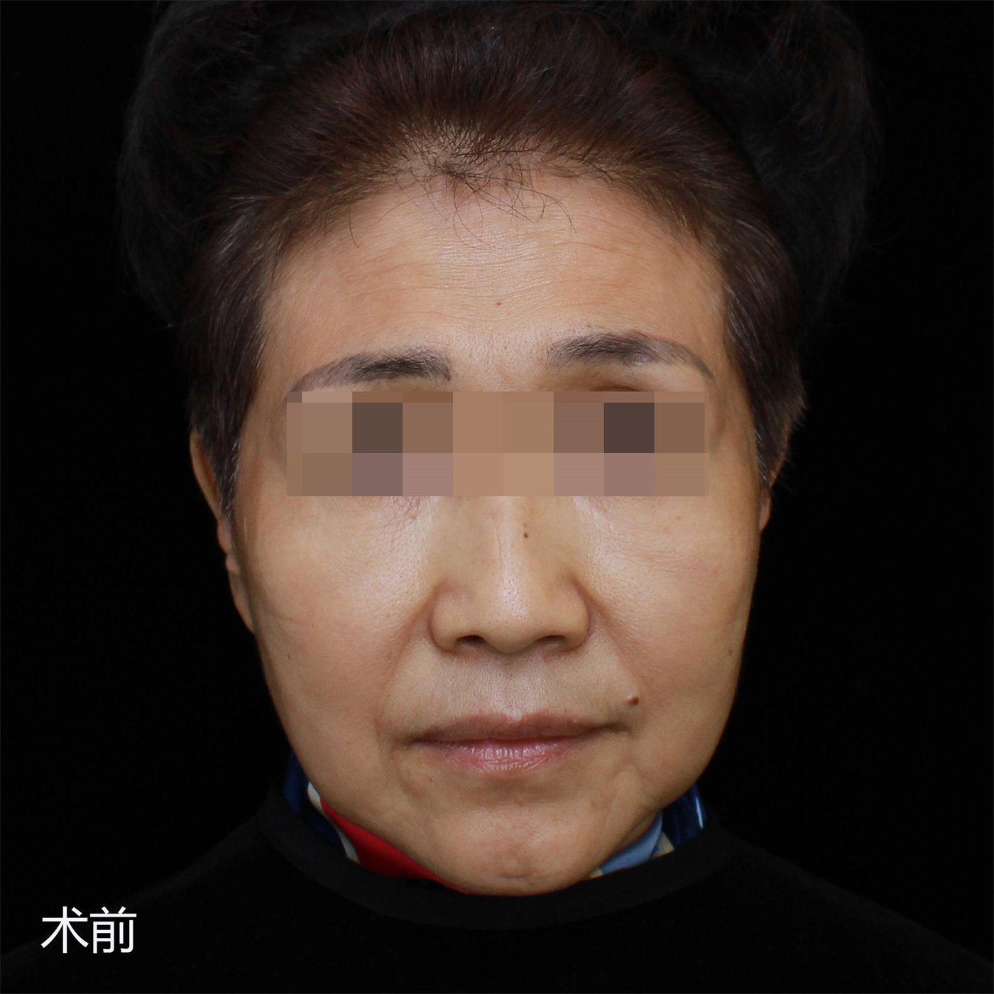 拉皮手术效果7天、30天、50天实拍记录，很惊艳！