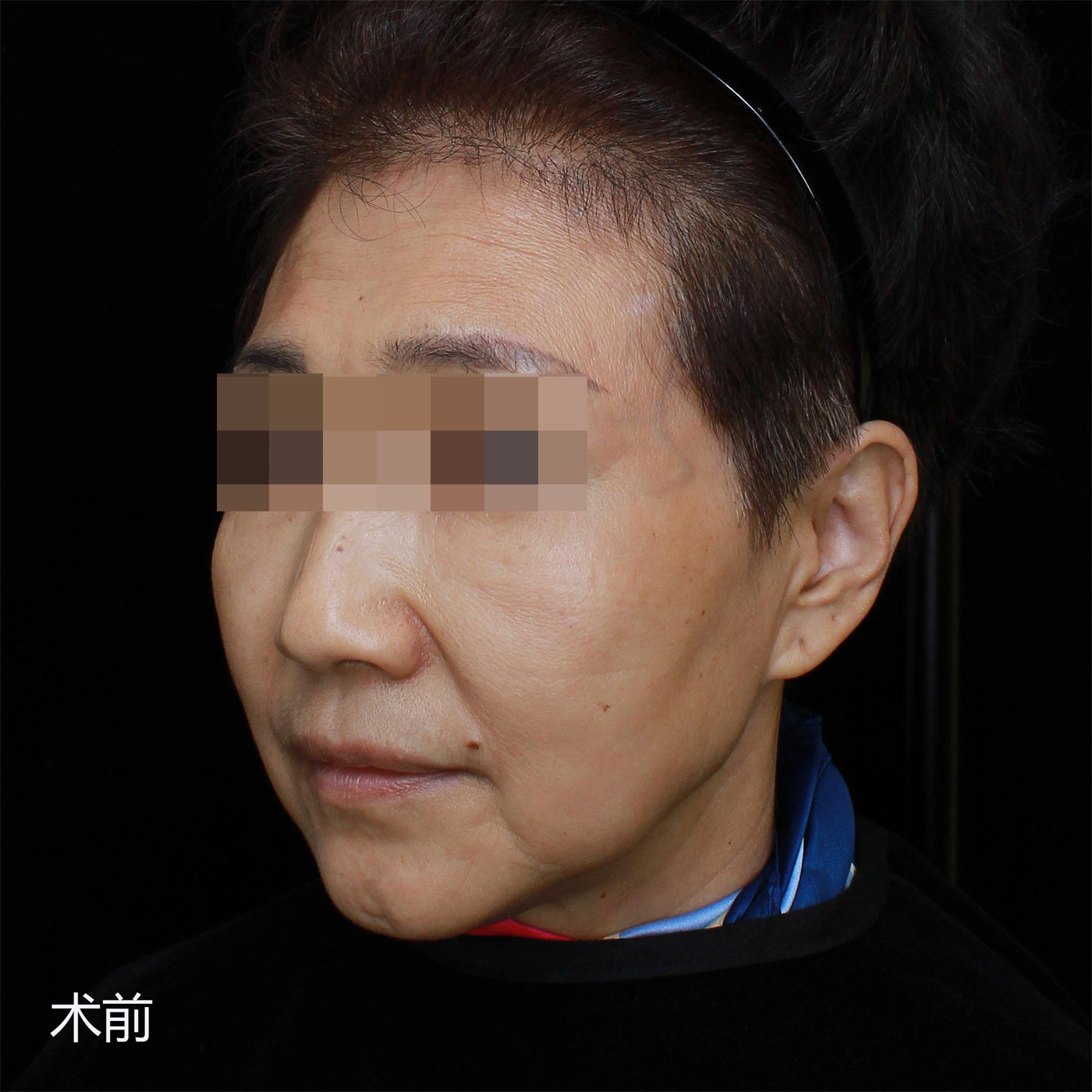 拉皮手术效果7天、30天、50天实拍记录，很惊艳！