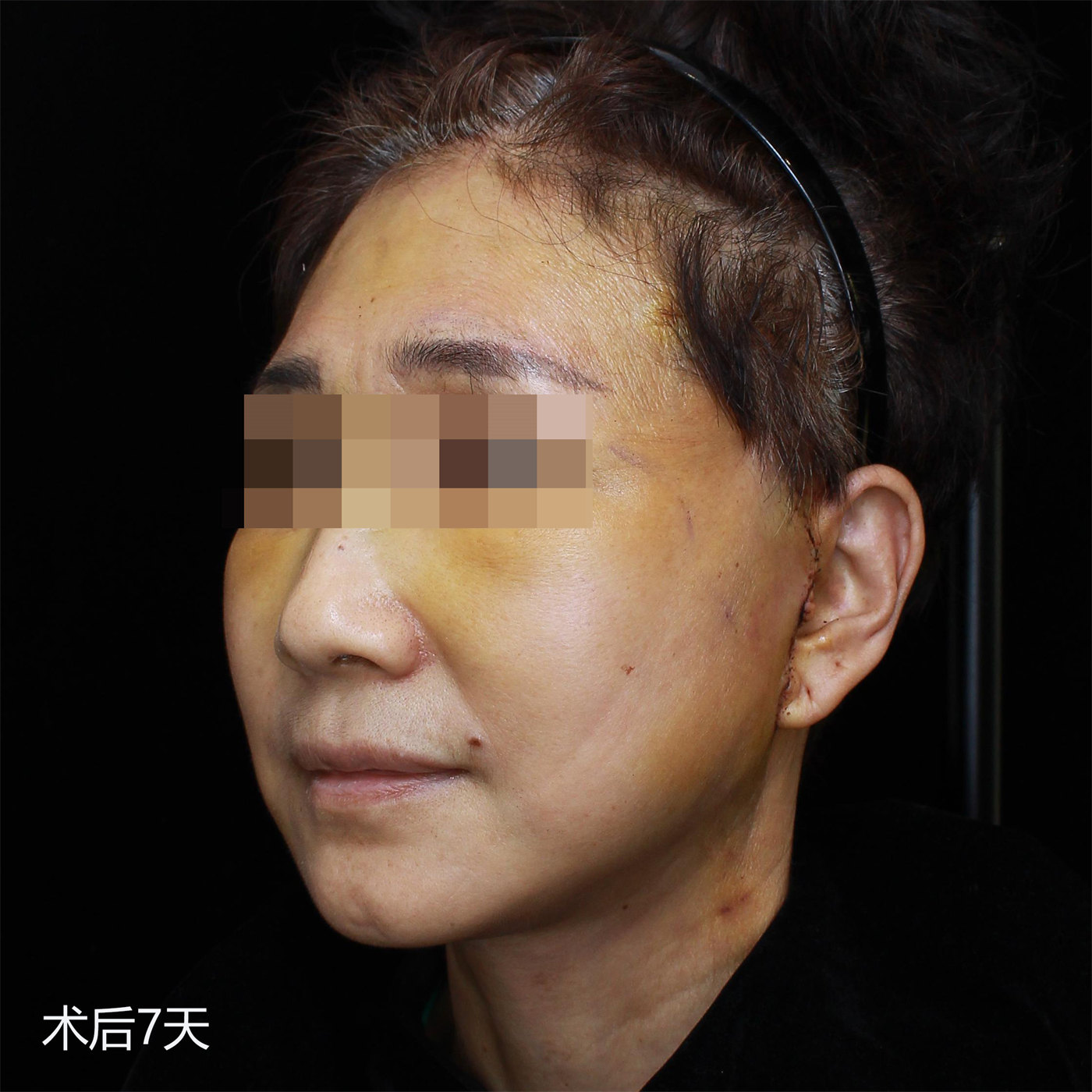 拉皮手术效果7天、30天、50天实拍记录，很惊艳！