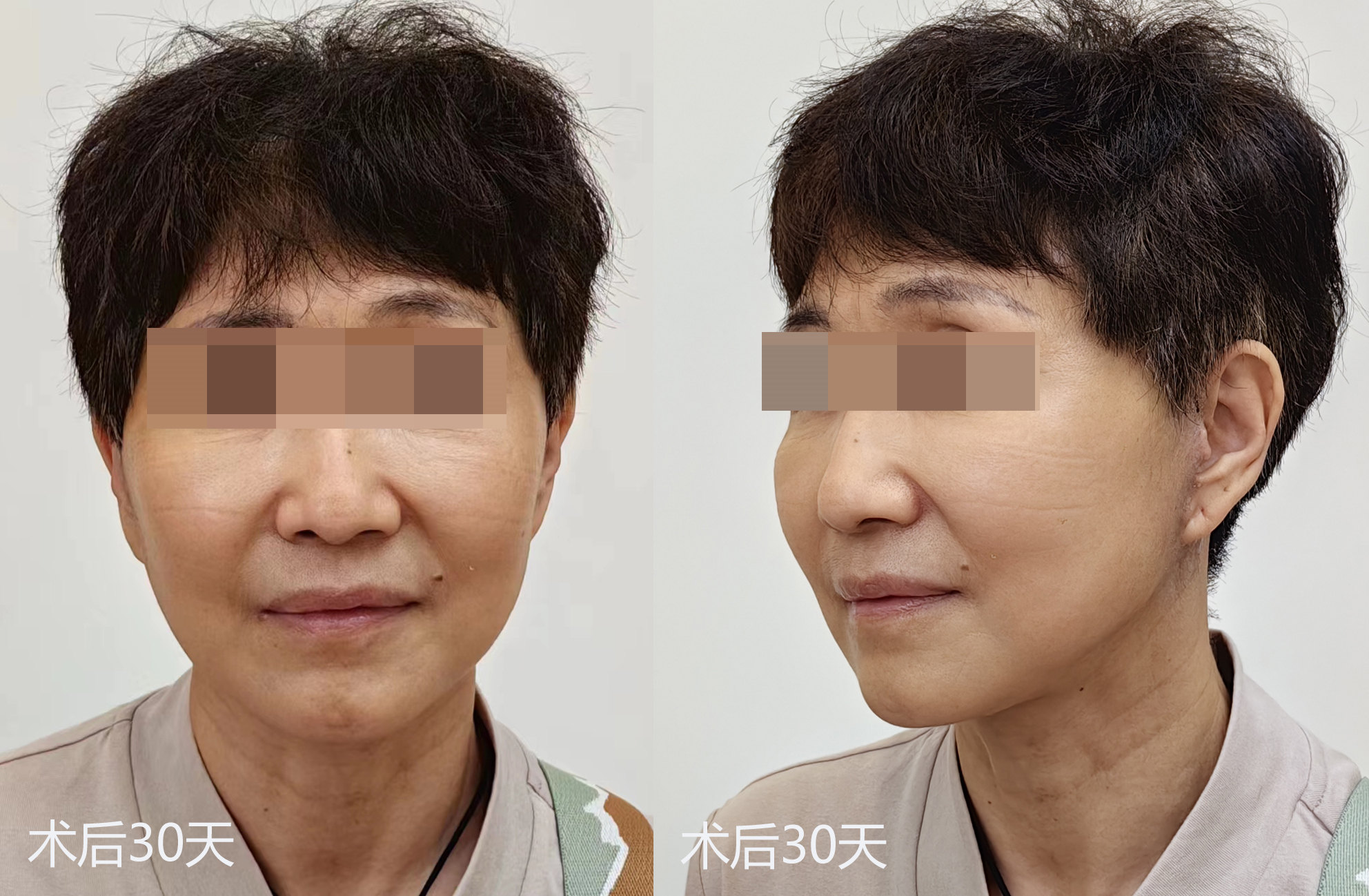 拉皮手术效果7天、30天、50天实拍记录，很惊艳！