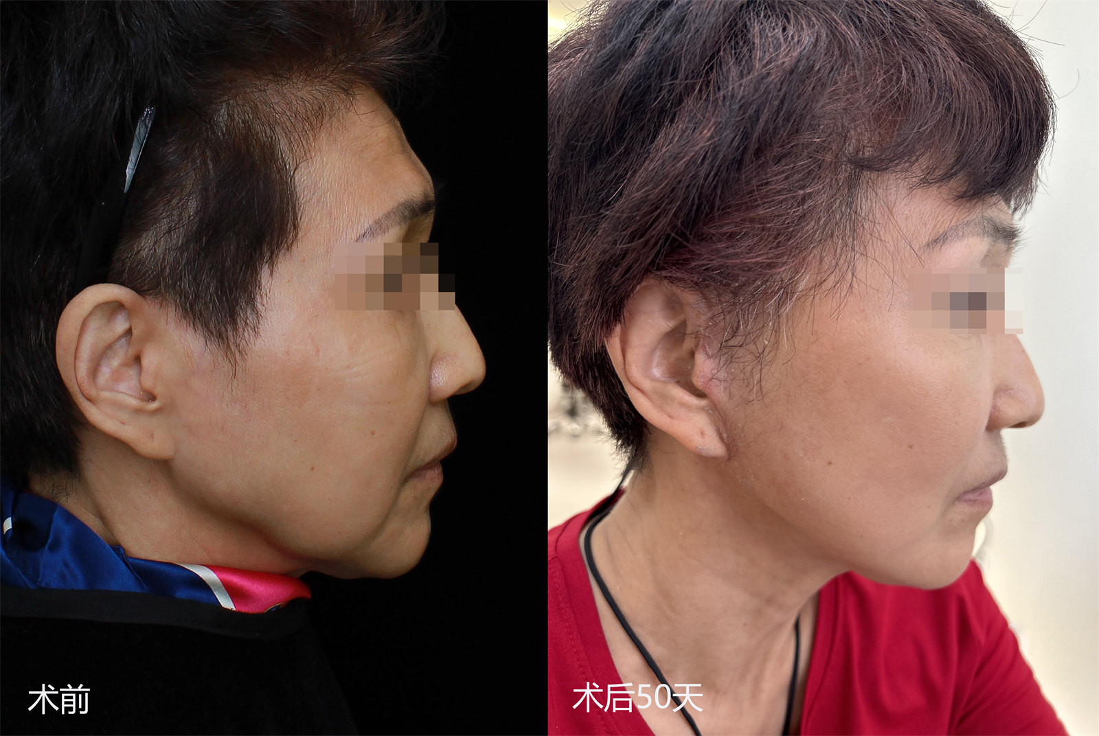 拉皮手术效果7天、30天、50天实拍记录，很惊艳！